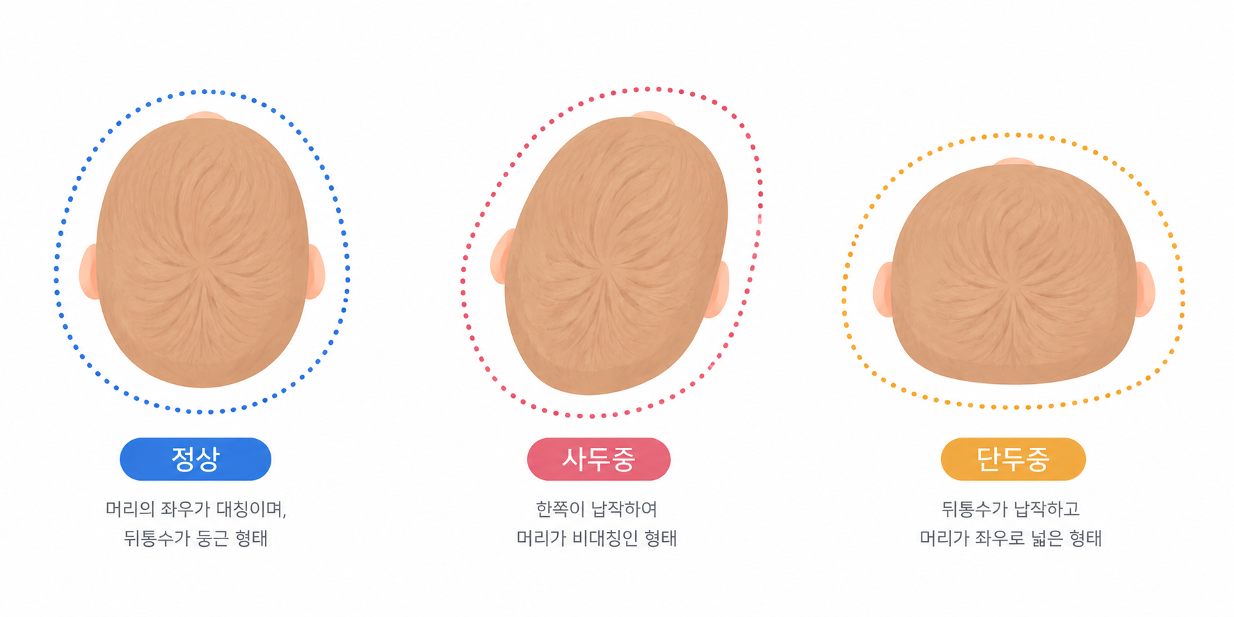 정상, 사두증, 단두증 두상 비교